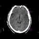 Brain ischemia, MCA, day 1: CT - Computed tomography